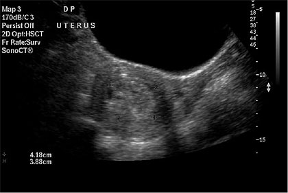 Ultrasound of Complete Molar Pregnancy